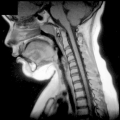 x-ray of child's neck