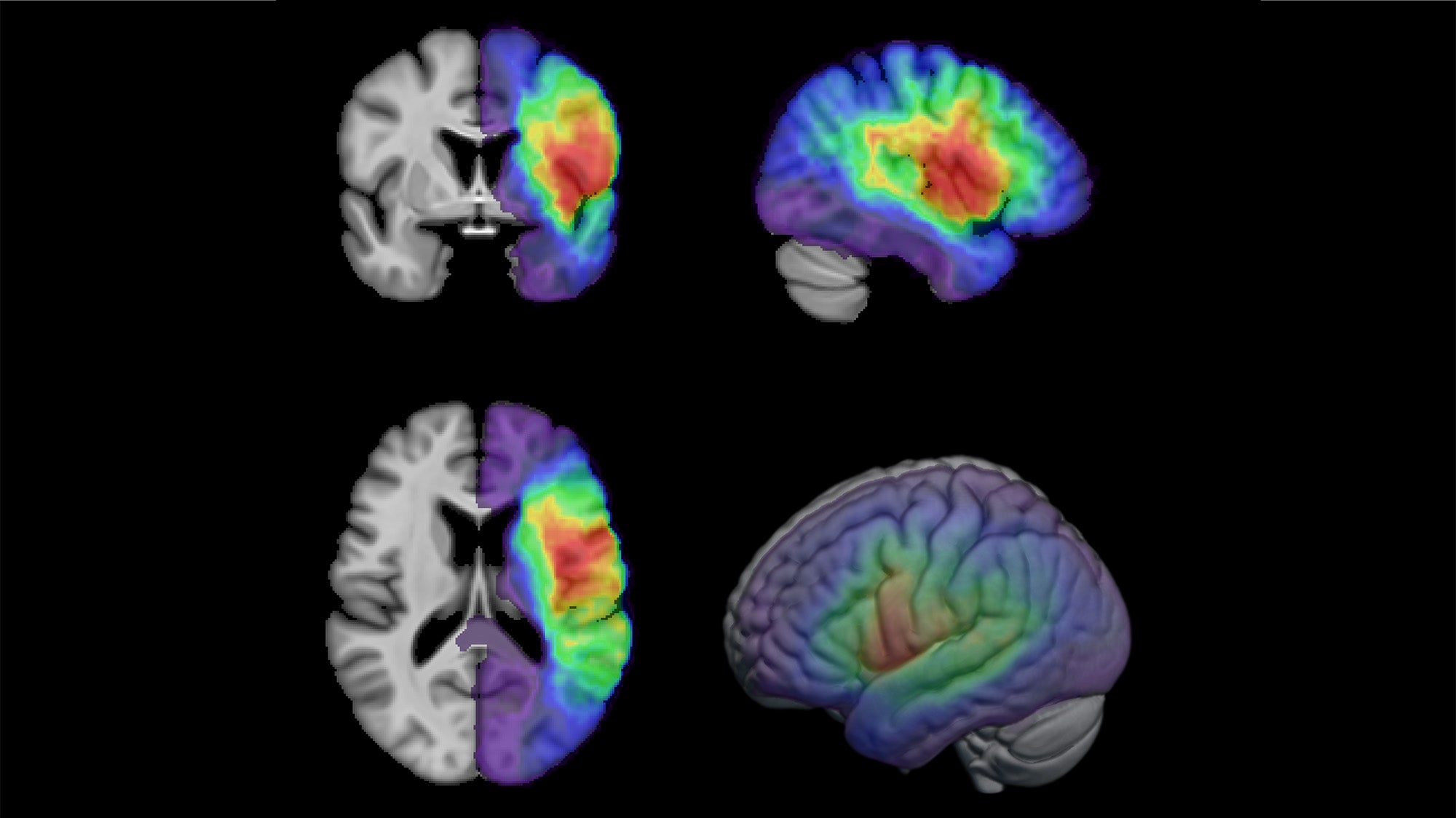 Four MRI brain scans showing different views